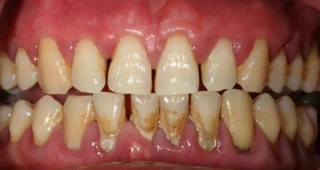 Evde bulunan malzemelerle diş tartarlarını ve plakları bu teknikle yok edin 1